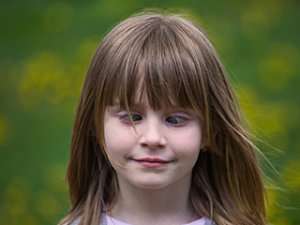 Young girl with Strabismus