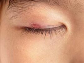 Blepharitis eyelid