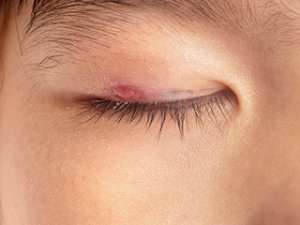 Blepharitis eyelid