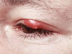 Chalazion on an Eyelid