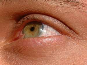 Pinguecula pterygium