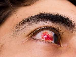 Subjunctive hemorrhage