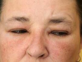 Swollen eyelids