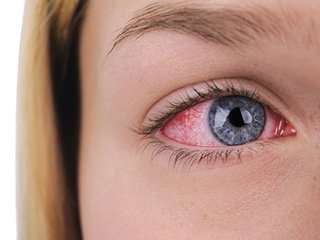 Woman with Conjunctivitis Pink Eye