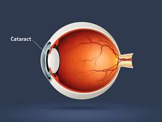 Cataract Chart
