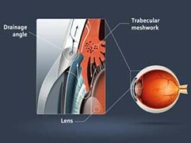 Glaucoma Diagram