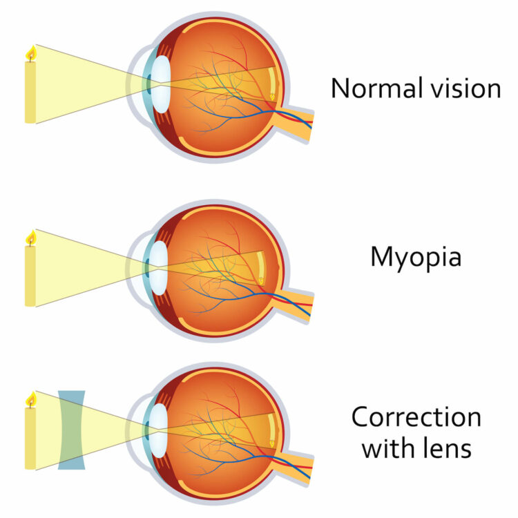 Diagram of Myopia