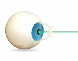 Laser cataract surgery diagram