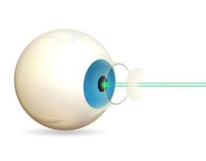Laser cataract surgery diagram
