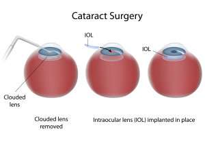 Cataract Surgery Chart Inserting an IOL