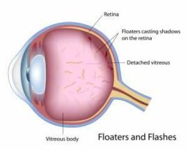 Floaters and Flashes Chart