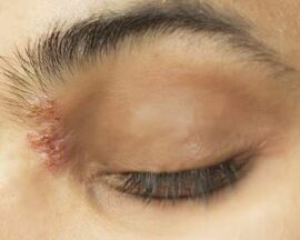 Skin irritation near eye