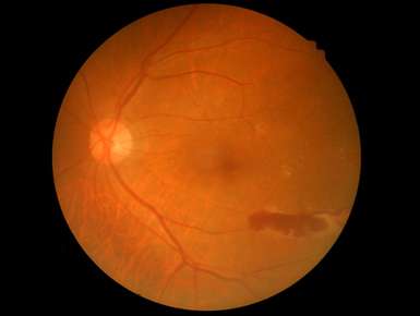 Diabetic Eye Disease Image