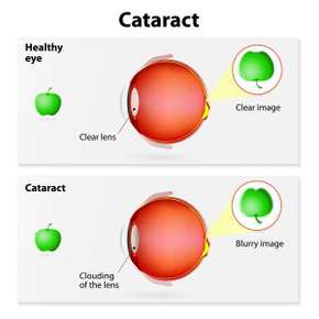 Cataract Chart